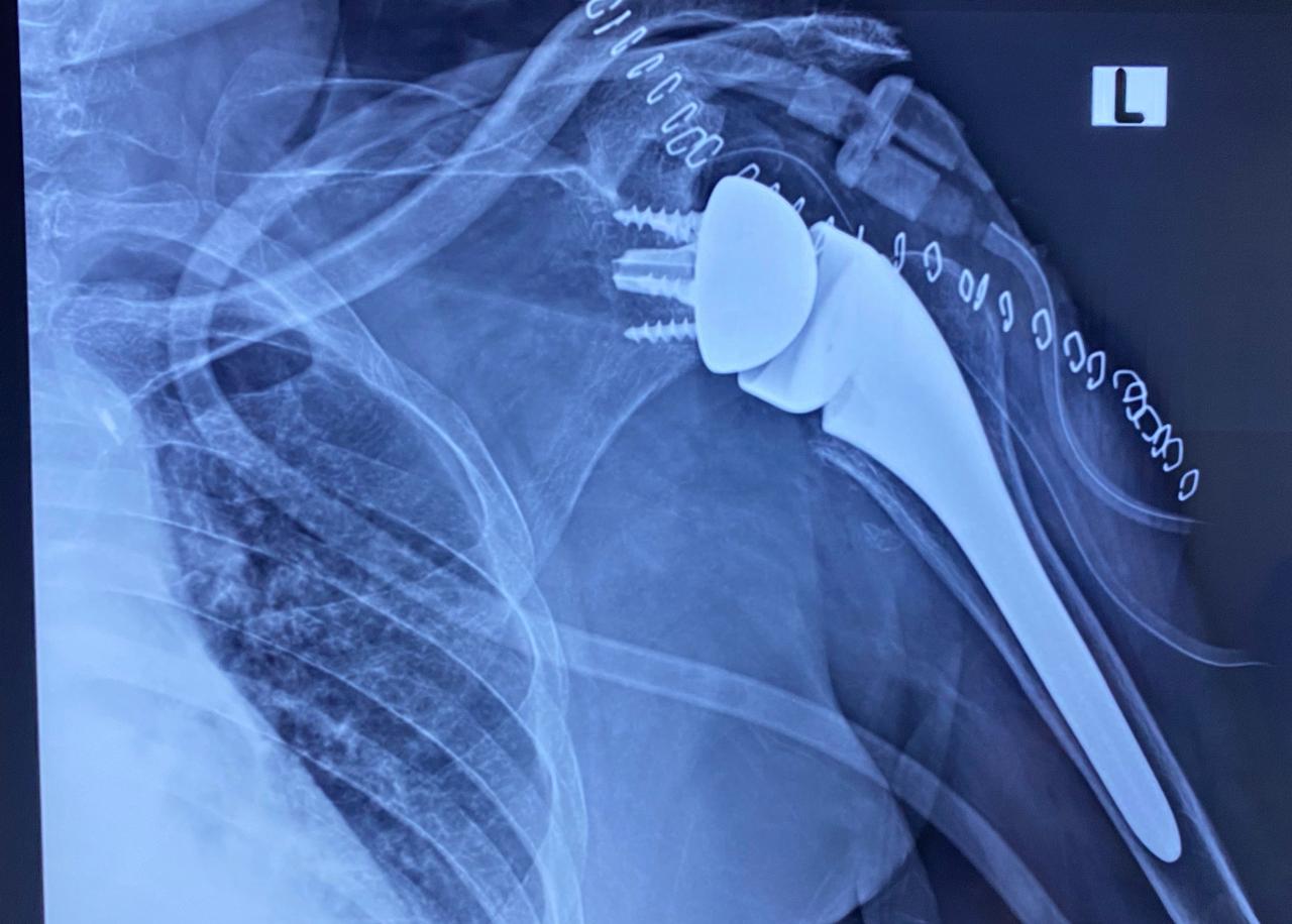 Shoulder Replacement Surgery procedure by Dr. Nikhil Bansal, an expert orthopedic surgeon restoring shoulder mobility and reducing pain.